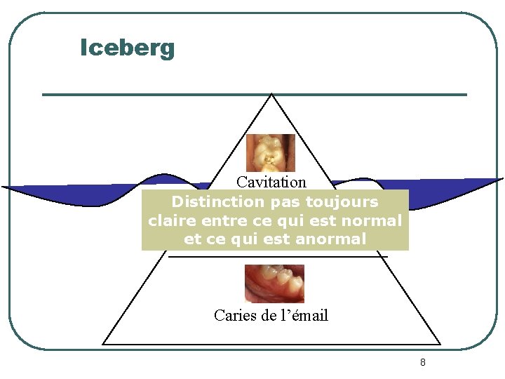 Iceberg Cavitation Distinction pas toujours claire entre ce qui est normal et cedentinaires qui Iceberg Cavitation Distinction pas toujours claire entre ce qui est normal et cedentinaires qui