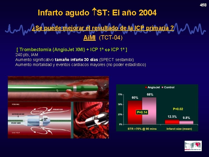 Infarto agudo ST: El año 2004 ¿Se puede mejorar el resultado de la ICP