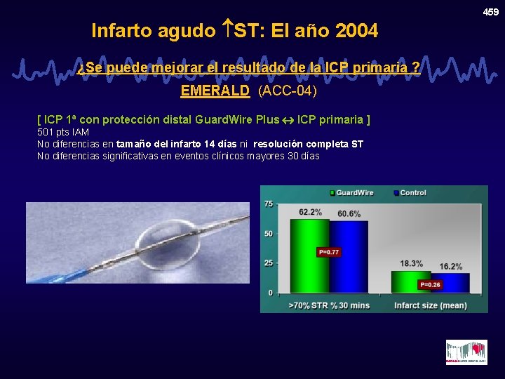 Infarto agudo ST: El año 2004 ¿Se puede mejorar el resultado de la ICP