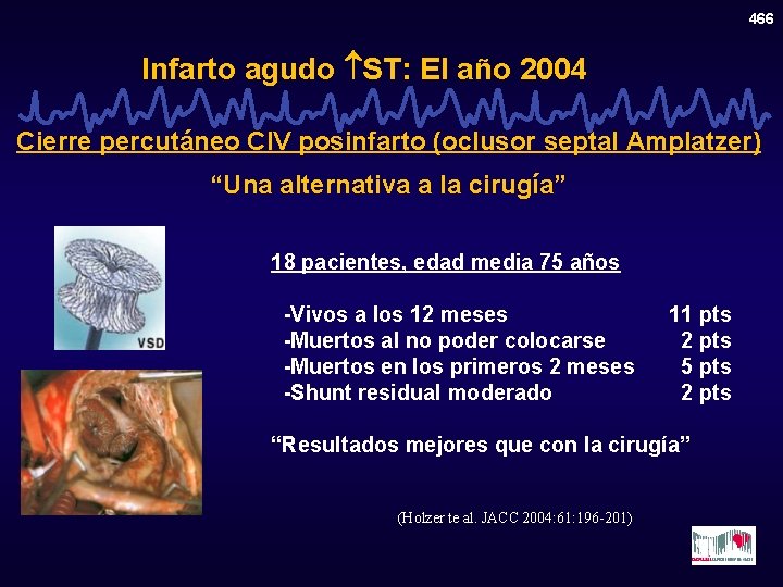 466 Infarto agudo ST: El año 2004 Cierre percutáneo CIV posinfarto (oclusor septal Amplatzer)