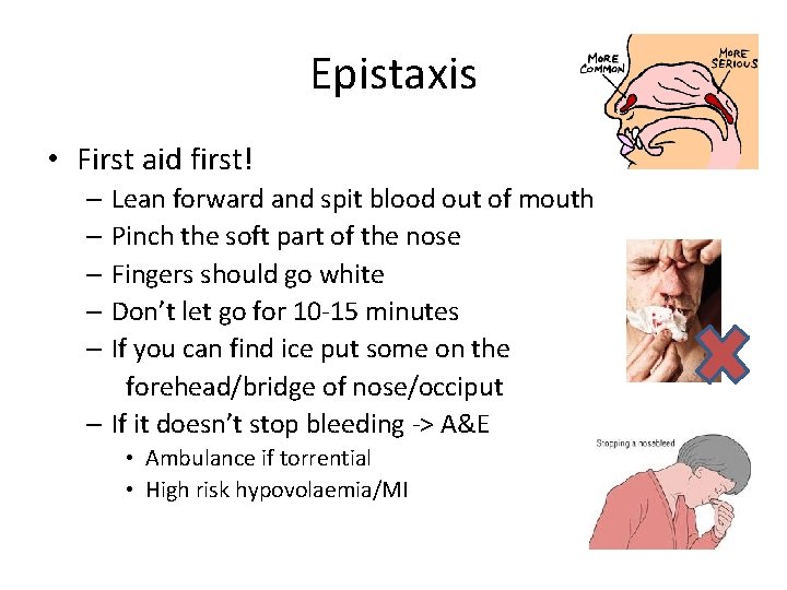 Epistaxis • First aid first! – Lean forward and spit blood out of mouth