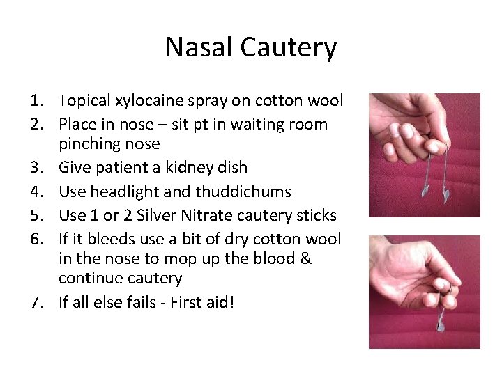 Nasal Cautery 1. Topical xylocaine spray on cotton wool 2. Place in nose –