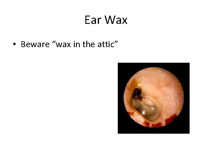 Ear Wax • Beware “wax in the attic” 