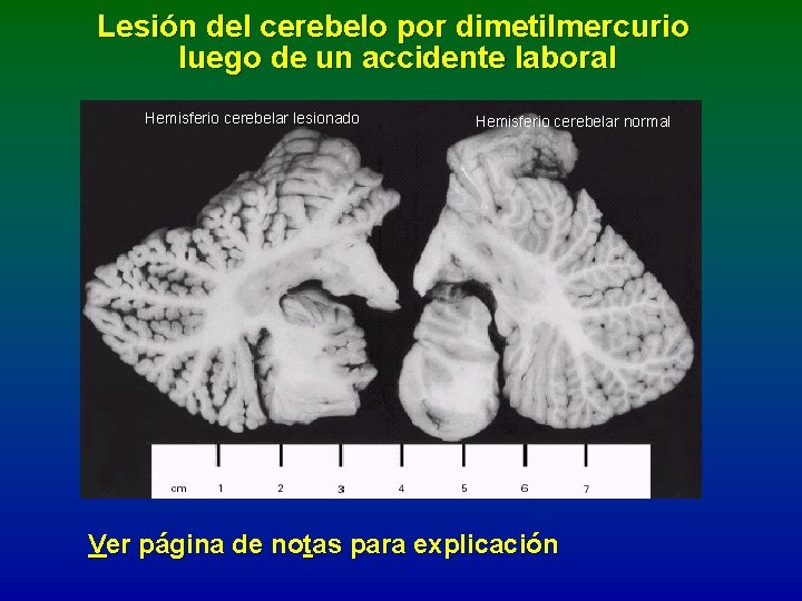 Lesión del cerebelo por dimetilmercurio luego de un accidente laboral Hemisferio cerebelar lesionado Hemisferio