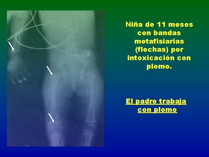 Niña de 11 meses con bandas metafisiarias (flechas) por intoxicación con plomo. El padre