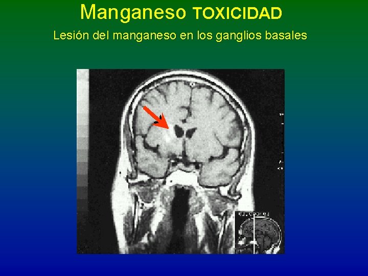 Manganeso TOXICIDAD Lesión del manganeso en los ganglios basales 