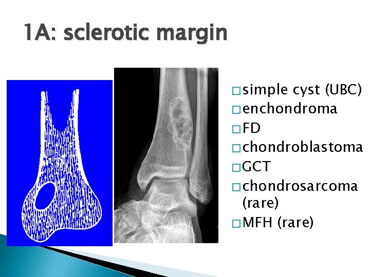 1 A: sclerotic margin � simple cyst (UBC) � enchondroma � FD � chondroblastoma 1 A: sclerotic margin � simple cyst (UBC) � enchondroma � FD � chondroblastoma
