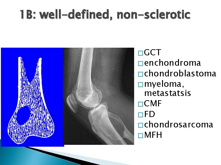 1 B: well-defined, non-sclerotic � GCT � enchondroma � chondroblastoma � myeloma, metastatsis � 1 B: well-defined, non-sclerotic � GCT � enchondroma � chondroblastoma � myeloma, metastatsis �