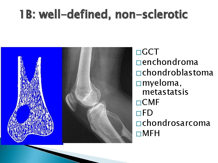 1 B: well-defined, non-sclerotic � GCT � enchondroma � chondroblastoma � myeloma, metastatsis �