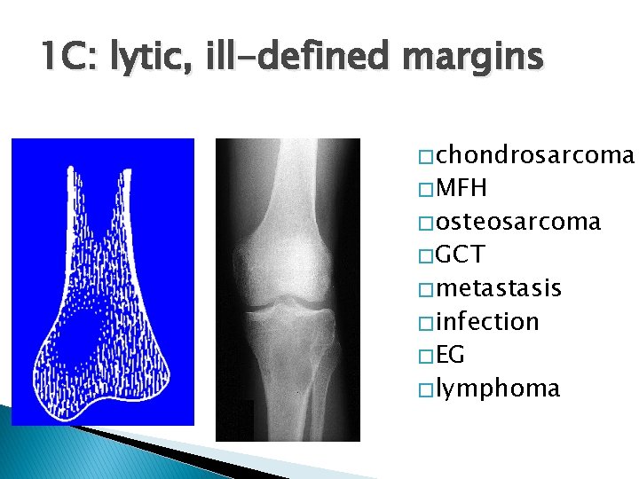 1 C: lytic, ill-defined margins � chondrosarcoma � MFH � osteosarcoma � GCT � 1 C: lytic, ill-defined margins � chondrosarcoma � MFH � osteosarcoma � GCT �