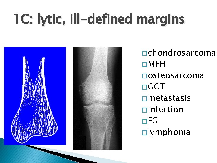 1 C: lytic, ill-defined margins � chondrosarcoma � MFH � osteosarcoma � GCT �