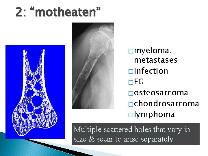 2: “motheaten” � myeloma, metastases � infection � EG � osteosarcoma � chondrosarcoma �