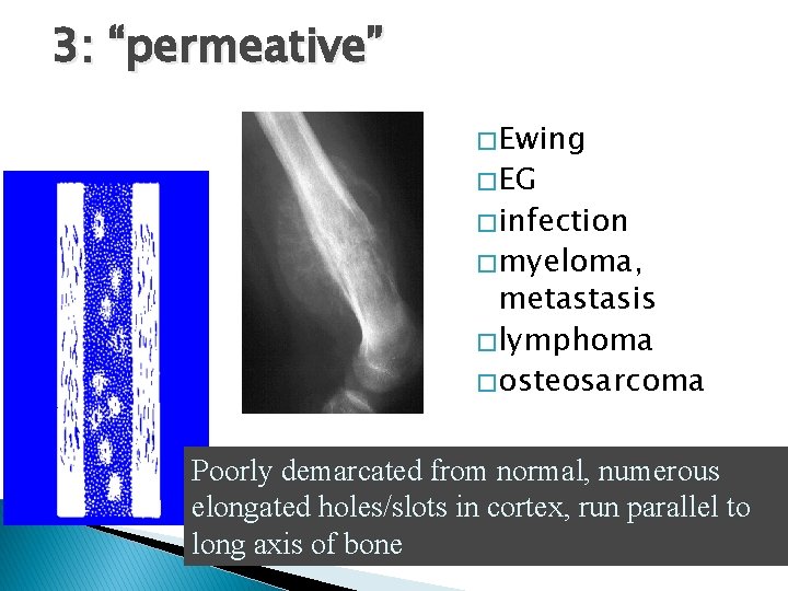 3: “permeative” � Ewing � EG � infection � myeloma, metastasis � lymphoma � 3: “permeative” � Ewing � EG � infection � myeloma, metastasis � lymphoma �