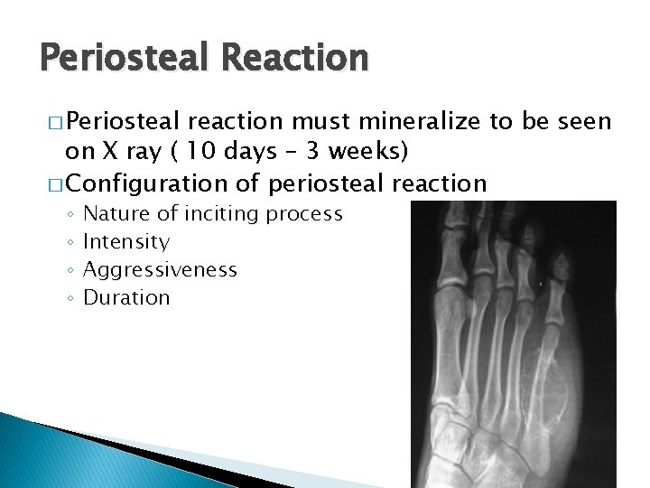 Periosteal Reaction � Periosteal reaction must mineralize to be seen on X ray ( Periosteal Reaction � Periosteal reaction must mineralize to be seen on X ray (