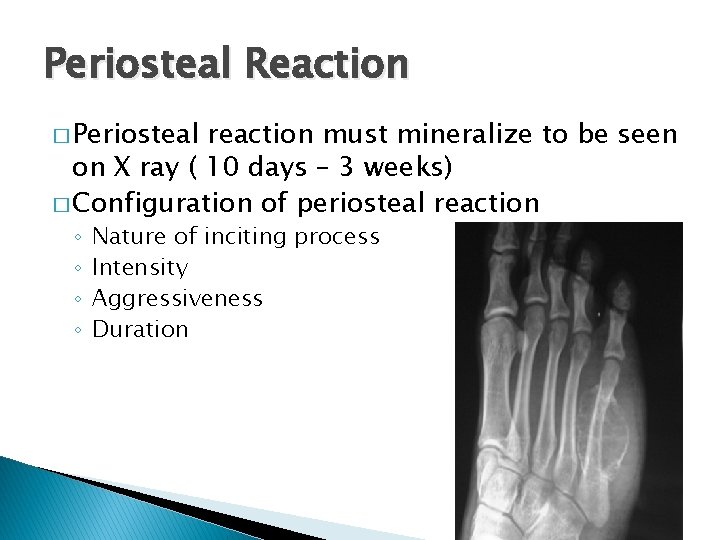 Periosteal Reaction � Periosteal reaction must mineralize to be seen on X ray (