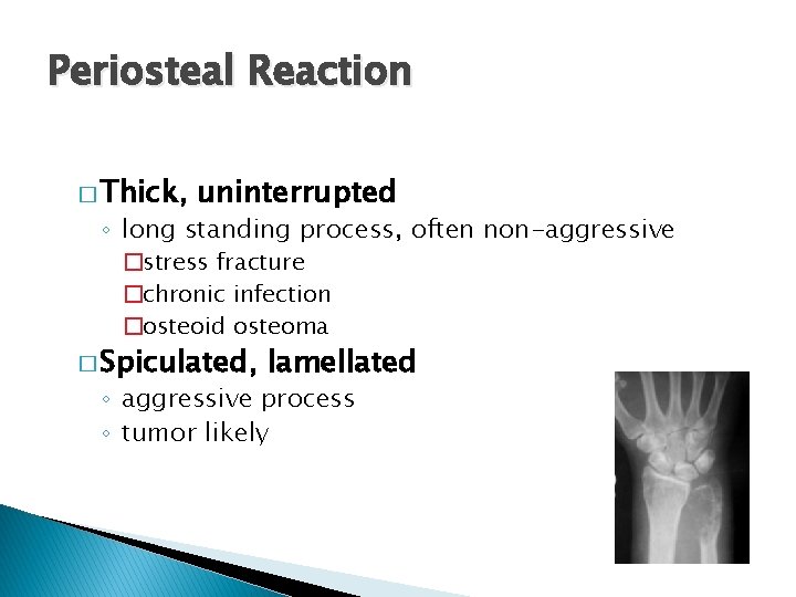Periosteal Reaction � Thick, uninterrupted ◦ long standing process, often non-aggressive �stress fracture �chronic Periosteal Reaction � Thick, uninterrupted ◦ long standing process, often non-aggressive �stress fracture �chronic
