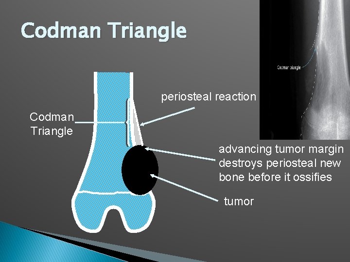 Codman Triangle periosteal reaction Codman Triangle advancing tumor margin destroys periosteal new bone before Codman Triangle periosteal reaction Codman Triangle advancing tumor margin destroys periosteal new bone before
