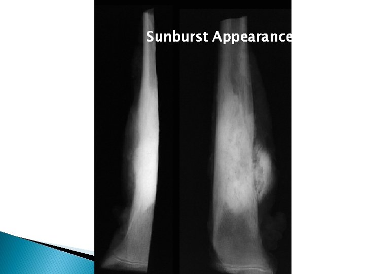 Sunburst Appearance  Sunburst Appearance