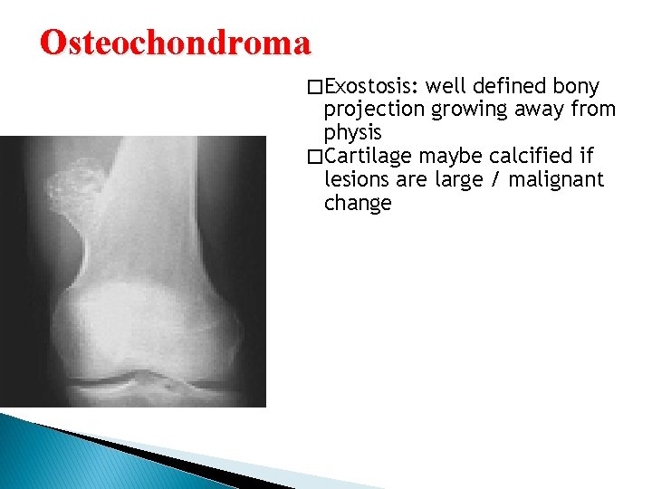 Osteochondroma �Exostosis: well defined bony projection growing away from physis �Cartilage maybe calcified if Osteochondroma �Exostosis: well defined bony projection growing away from physis �Cartilage maybe calcified if