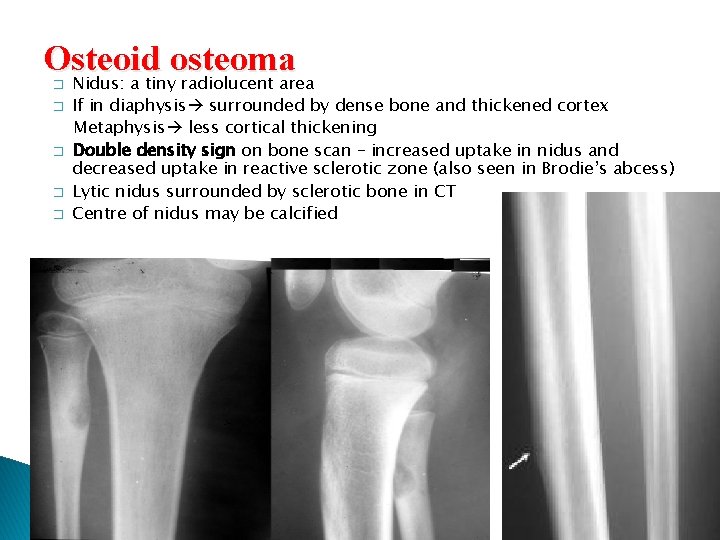 Osteoid osteoma Nidus: a tiny radiolucent area � � � If in diaphysis surrounded