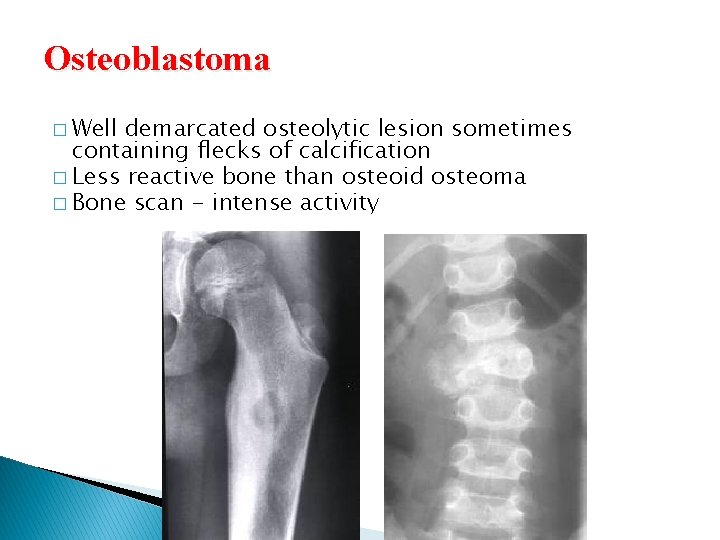 Osteoblastoma � Well demarcated osteolytic lesion sometimes containing flecks of calcification � Less reactive Osteoblastoma � Well demarcated osteolytic lesion sometimes containing flecks of calcification � Less reactive