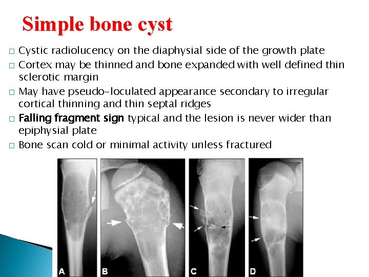 Simple bone cyst � � � Cystic radiolucency on the diaphysial side of the