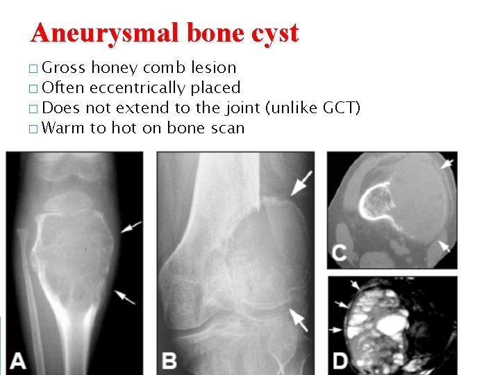Aneurysmal bone cyst � Gross honey comb lesion � Often eccentrically placed � Does