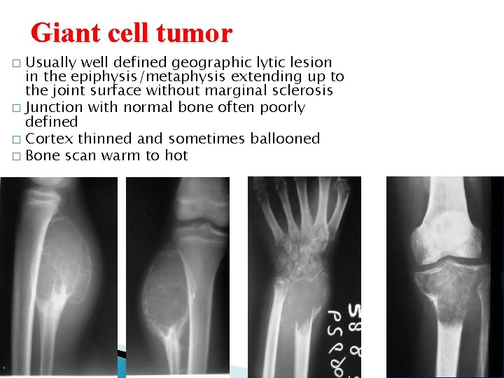 Giant cell tumor Usually well defined geographic lytic lesion in the epiphysis/metaphysis extending up Giant cell tumor Usually well defined geographic lytic lesion in the epiphysis/metaphysis extending up