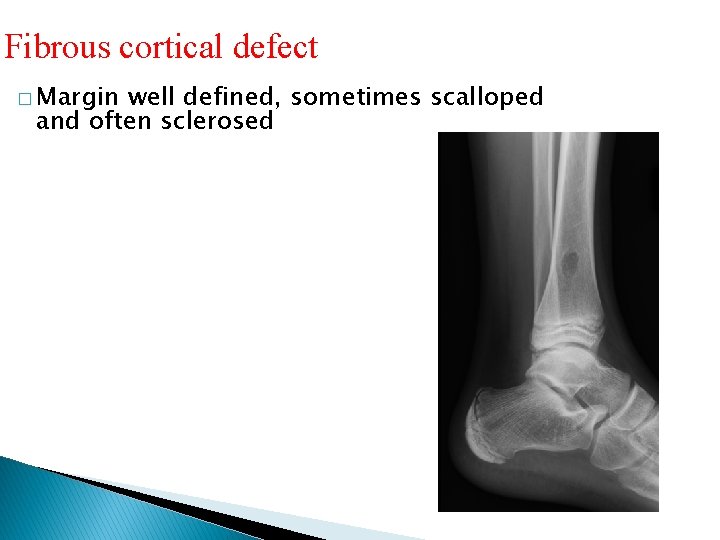 Fibrous cortical defect � Margin well defined, sometimes scalloped and often sclerosed 