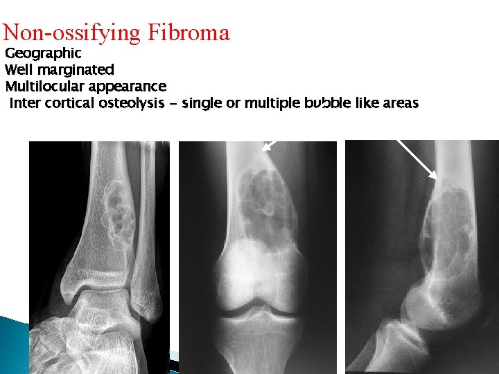 Non-ossifying Fibroma Geographic Well marginated Multilocular appearance Inter cortical osteolysis - single or multiple Non-ossifying Fibroma Geographic Well marginated Multilocular appearance Inter cortical osteolysis - single or multiple