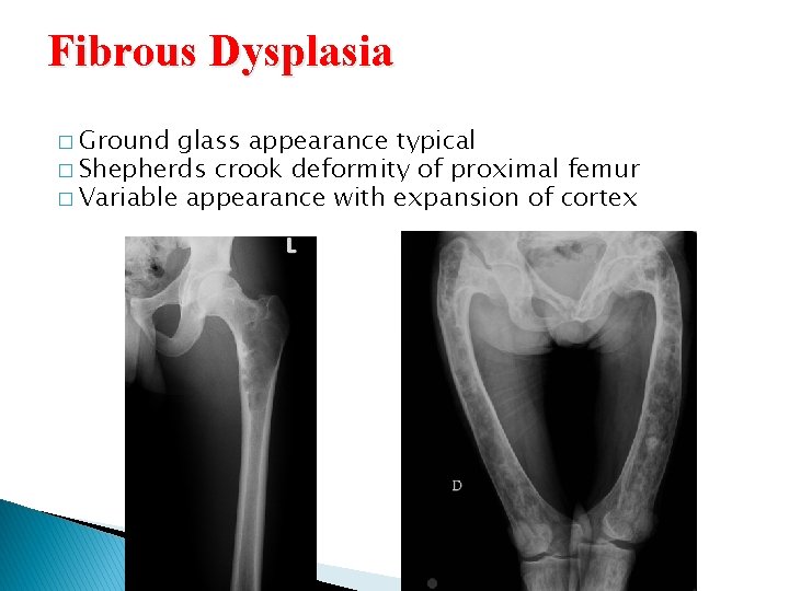 Fibrous Dysplasia � Ground glass appearance typical � Shepherds crook deformity of proximal femur Fibrous Dysplasia � Ground glass appearance typical � Shepherds crook deformity of proximal femur