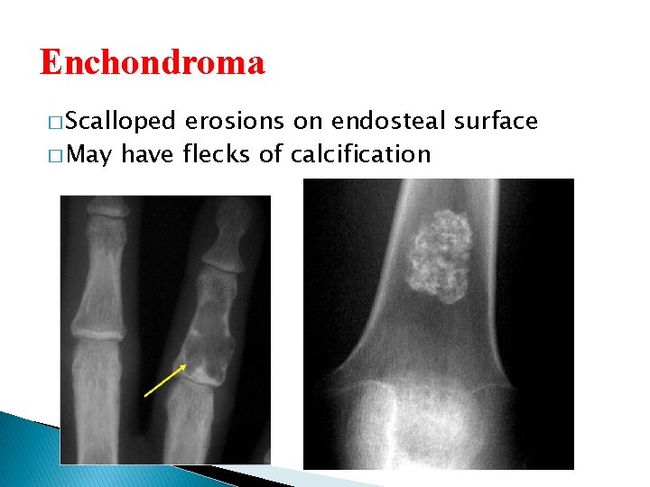 Enchondroma � Scalloped erosions on endosteal surface � May have flecks of calcification 