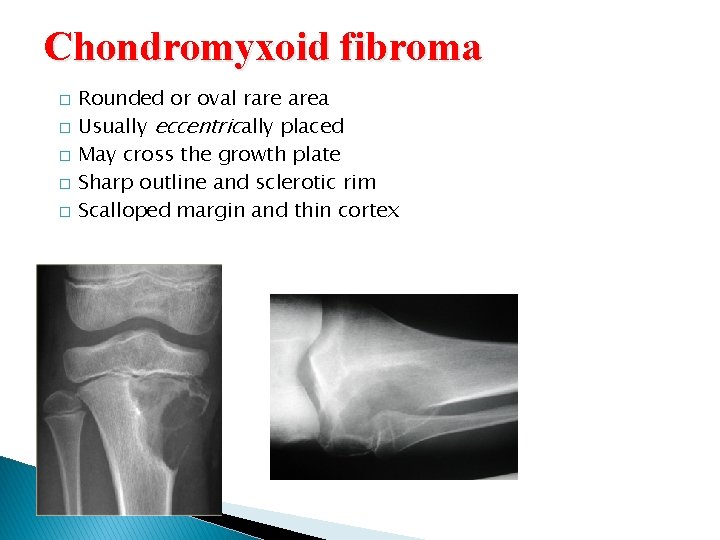Chondromyxoid fibroma � � � Rounded or oval rare area Usually eccentrically placed May Chondromyxoid fibroma � � � Rounded or oval rare area Usually eccentrically placed May