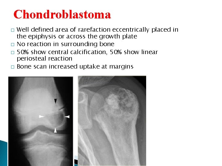 Chondroblastoma � � Well defined area of rarefaction eccentrically placed in the epiphysis or Chondroblastoma � � Well defined area of rarefaction eccentrically placed in the epiphysis or