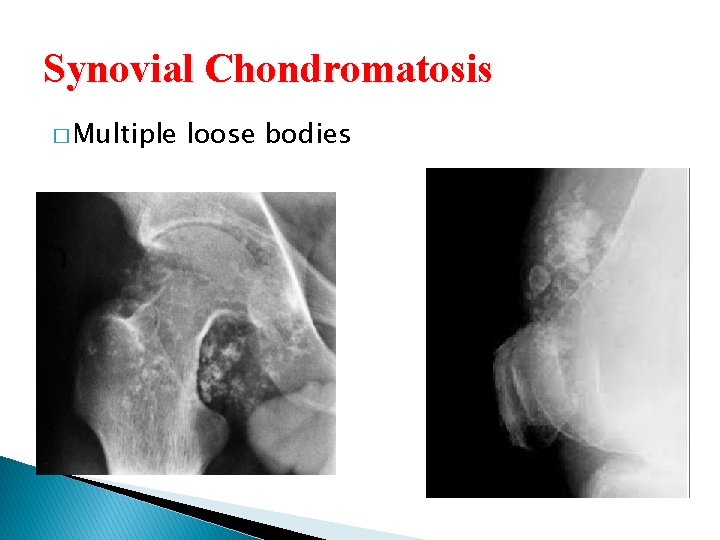 Synovial Chondromatosis � Multiple loose bodies  Synovial Chondromatosis � Multiple loose bodies