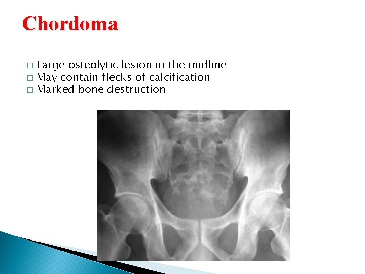 Chordoma Large osteolytic lesion in the midline � May contain flecks of calcification � Chordoma Large osteolytic lesion in the midline � May contain flecks of calcification �