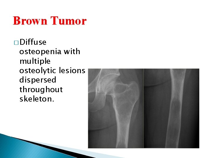 Brown Tumor � Diffuse osteopenia with multiple osteolytic lesions dispersed throughout skeleton. 