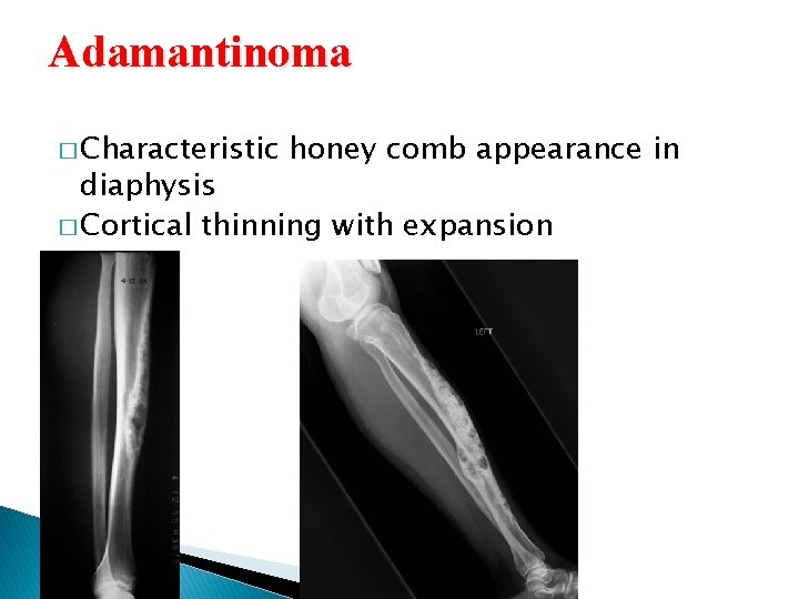 Adamantinoma � Characteristic honey comb appearance in diaphysis � Cortical thinning with expansion  Adamantinoma � Characteristic honey comb appearance in diaphysis � Cortical thinning with expansion