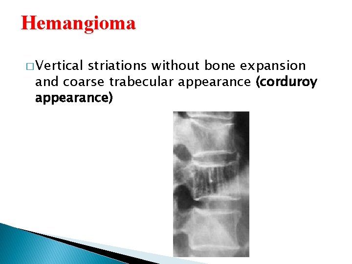 Hemangioma � Vertical striations without bone expansion and coarse trabecular appearance (corduroy appearance)  Hemangioma � Vertical striations without bone expansion and coarse trabecular appearance (corduroy appearance)