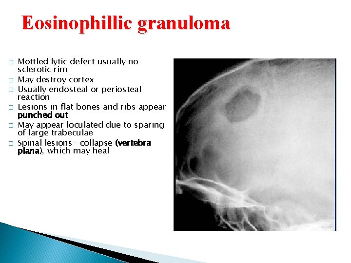 Eosinophillic granuloma � � � Mottled lytic defect usually no sclerotic rim May destroy Eosinophillic granuloma � � � Mottled lytic defect usually no sclerotic rim May destroy