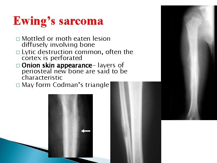 Ewing’s sarcoma Mottled or moth eaten lesion diffusely involving bone � Lytic destruction common,