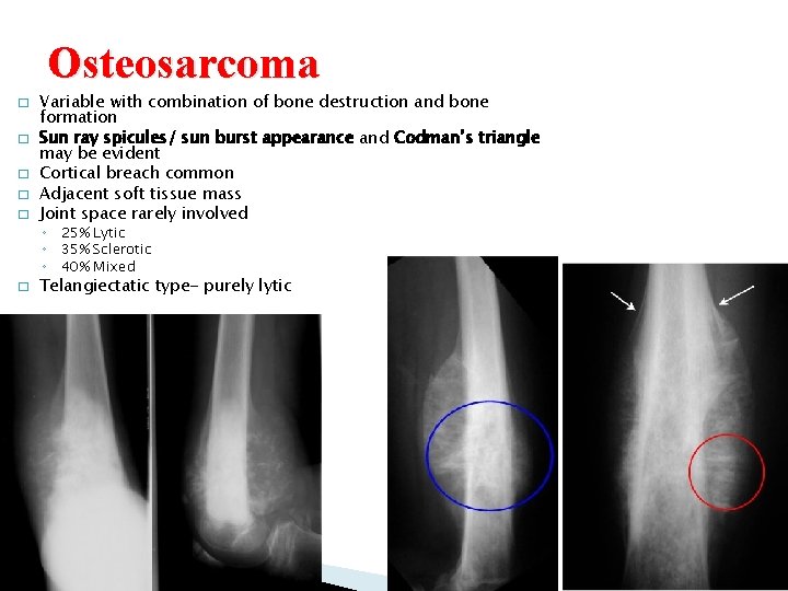 Osteosarcoma � � � Variable with combination of bone destruction and bone formation Sun Osteosarcoma � � � Variable with combination of bone destruction and bone formation Sun