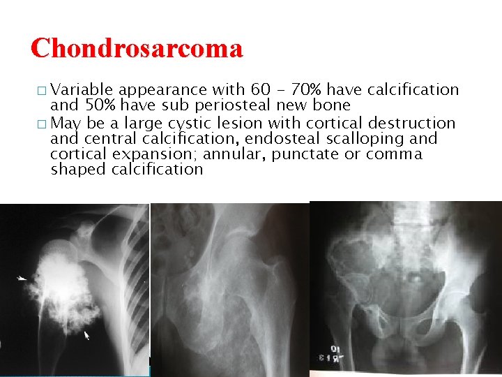 Chondrosarcoma � Variable appearance with 60 - 70% have calcification and 50% have sub