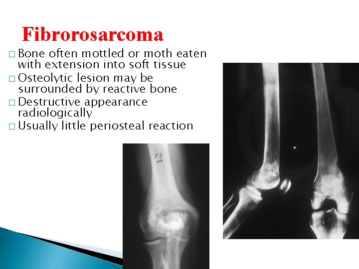 Fibrorosarcoma � Bone often mottled or moth eaten with extension into soft tissue � Fibrorosarcoma � Bone often mottled or moth eaten with extension into soft tissue �
