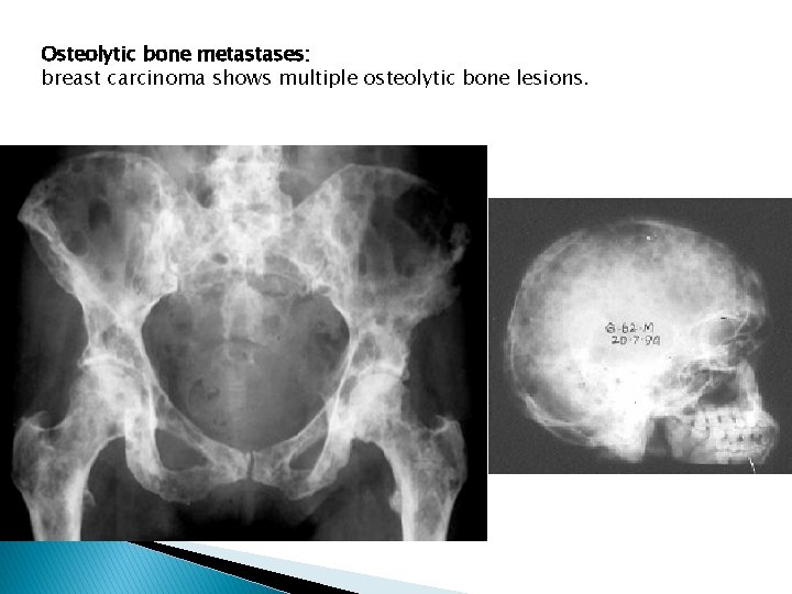 Osteolytic bone metastases: breast carcinoma shows multiple osteolytic bone lesions.  Osteolytic bone metastases: breast carcinoma shows multiple osteolytic bone lesions.