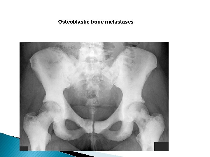 Osteoblastic bone metastases 