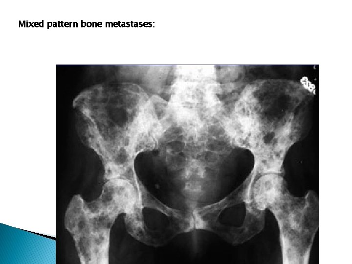 Mixed pattern bone metastases: 