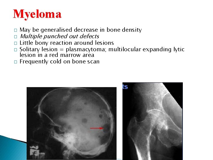 Myeloma � � � May be generalised decrease in bone density Multiple punched out
