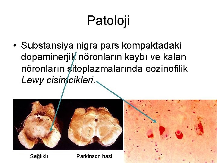 Patoloji • Substansiya nigra pars kompaktadaki dopaminerjik nöronların kaybı ve kalan nöronların sitoplazmalarında eozinofilik