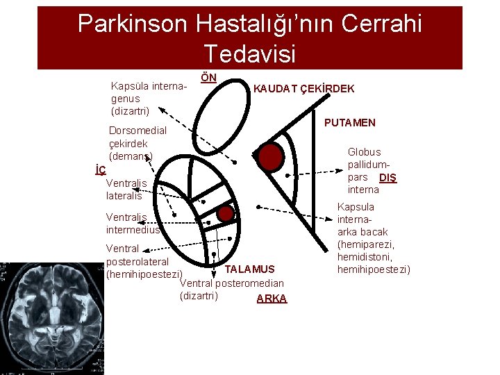 Parkinson Hastalığı’nın Cerrahi Tedavisi Kapsüla internagenus (dizartri) ÖN KAUDAT ÇEKİRDEK Dorsomedial çekirdek (demans) İÇ